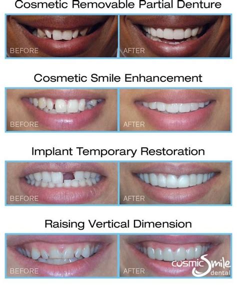 Snap-On Smile Before and After pictures #NaturalSkinCare | Dental cosmetics, Snap on smile ...