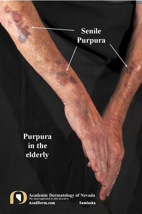 SenilePurpura3Samlaska - Academic Dermatology of Nevada