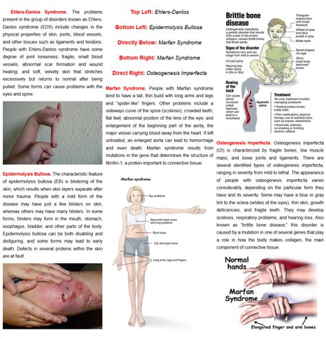 Pin by RAAID (Raising Awareness of Autoimmune Disease) on Connective Tissue Diseases | Disorders ...