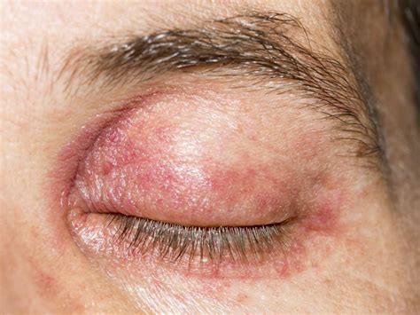 12 causes and treatments of a swollen eyelid: Stye, chalazion, allergies