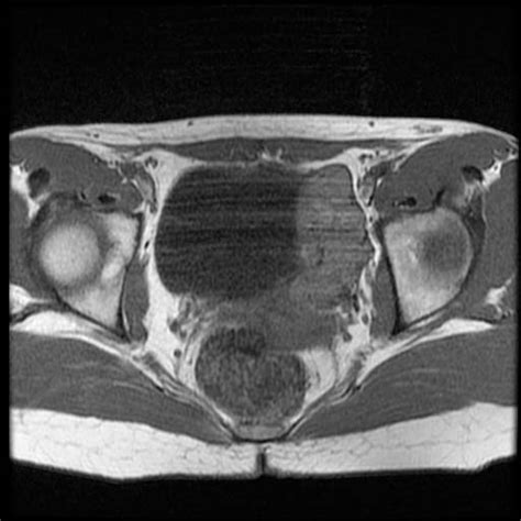 Pheochromocytoma MRI - wikidoc