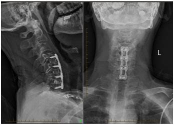 Anterior Cervical Discectomy & Fusion Surgery Westmead, NSW | ACDF Wahroonga, NSW