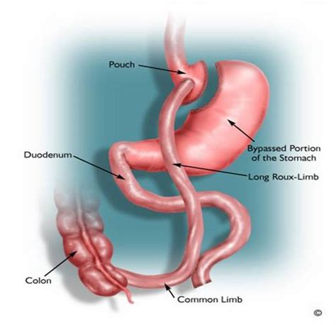 Roux-en-Y Gastric Bypass