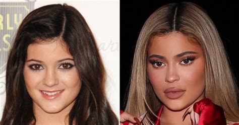 Did Kylie Jenner Get Plastic Surgery? See Transformation