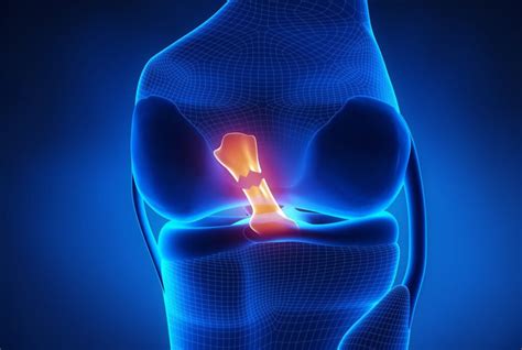 Recovering from your ACL Surgery | Van Sports & Physio