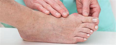 Hammer Toe: Symptoms and Treatments | Orange County Foot and Ankle Doctor