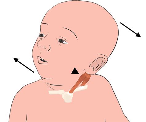 Fibromatosis colli leading to positional plagiocephaly with gross anatomical and sonographic ...