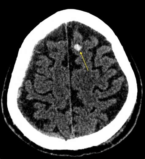 Cerebral contusion - Radiology at St. Vincent's University Hospital