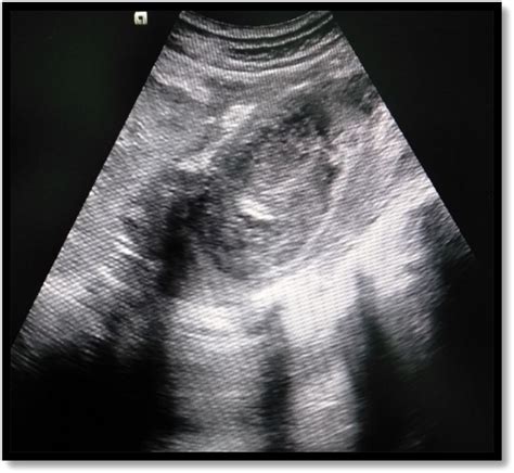 Presentation, management and outcomes of iliopsoas abscess at a University Teaching Hospital in ...