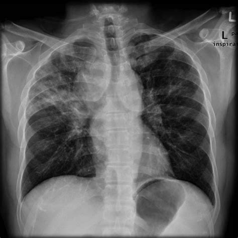 Sarcoidosis chest x ray - wikidoc