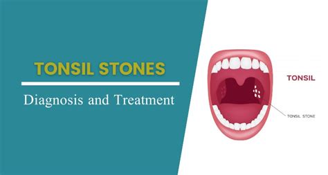 Tonsil Stones : Signs, Causes, Symptoms & Its Treatment | Adventis