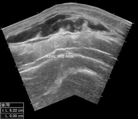 Encapsulated hematoma | Image | Radiopaedia.org