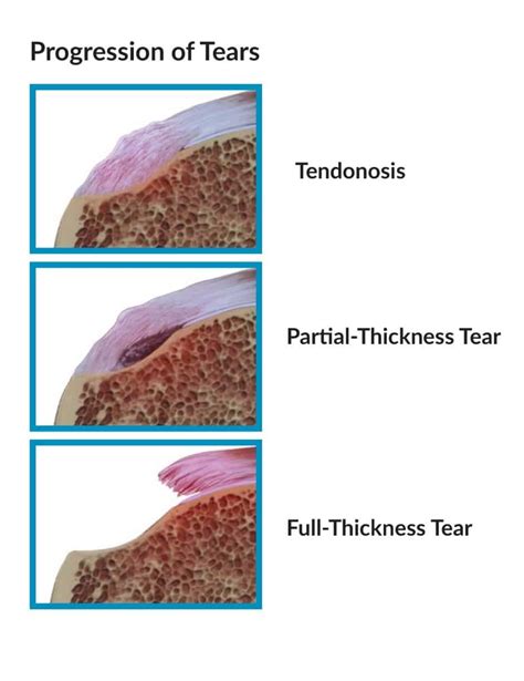 What is Rotator Cuff Tendinosis? – Howard J. Luks, MD