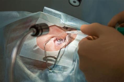 Lasik Eye Surgery for Astigmatism