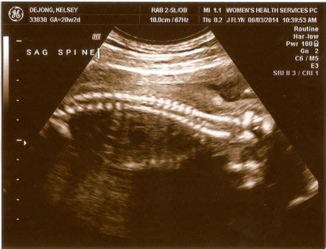 20 week ultrasound. ~ A Day with the De Jongs