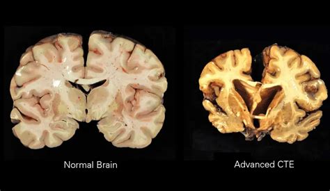 Know Your Brain: Chronic Traumatic Encephalopathy (CTE)