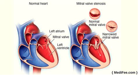 Mitral Valve Replacement