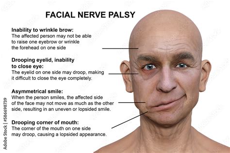 Facial palsy in a man, 3D illustration highlighting the asymmetry and drooping of the facial ...