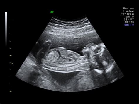 Private Early Pregnancy Scans Explained - What Will I See? - Ultrasound ...