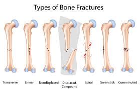 BONE FRACTURES - The System: Art & Science of Coaching