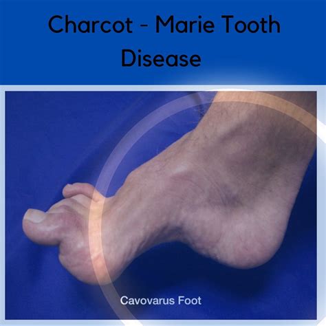 Charcot Marie Tooth Disease