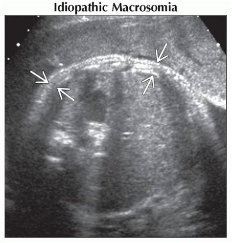 Macrosomia | Obgyn Key