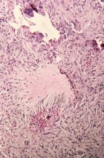 Histiocytoma (Benign Fibrous Histiocytoma) - Pathology - Orthobullets