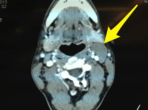 What is a Branchial Cleft Cyst? - Isaac Namdar, MD