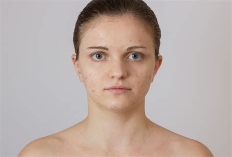 Hormonal Acne: Causes & Treatment Options - eMediHealth