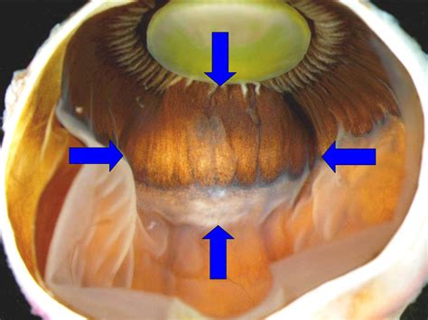 Clinicopathologic Correlation: Ciliary Body Leiomyoma. EyeRounds.org ...