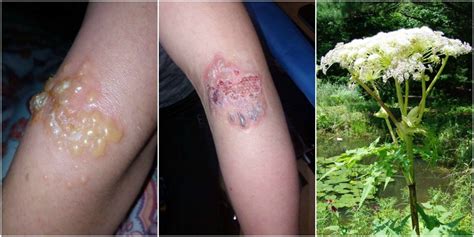 Crumlin girl (14) suffered third degree burns from toxic giant hogweed plant | Echo.ie