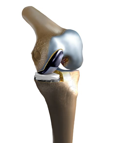 Who is a good candidate for partial knee replacement - Ortho Illinois