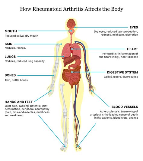 Rheumatoid Arthritis: The 4 Stages of Rheumatoid Arthritis