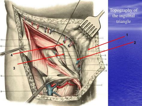 Anatomy Topography Of Inguinal And Femoral Hernia Victorian Anatomical | Images and Photos finder