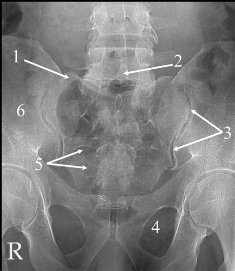 Sacroiliac Joint X Ray Positioning