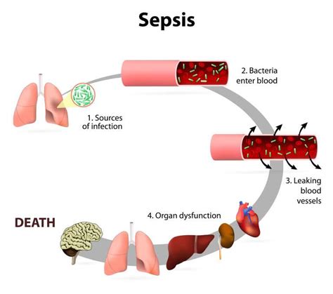 Disease profile: Sepsis - Health Issues India