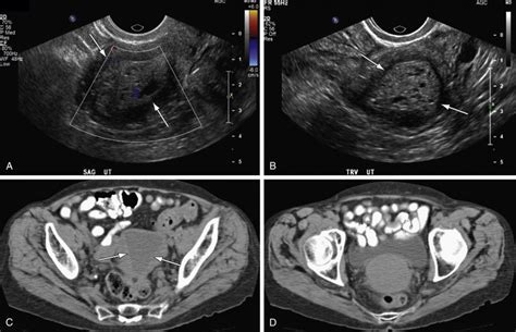 Uterine Cancers | Radiology Key