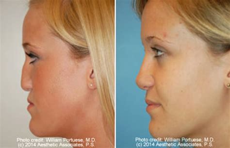 Have a Flat Nose? Rhinoplasty Can Fix That