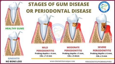 Periodontitis & Gingivitis Meaning Symptoms Tx | Gum Disease