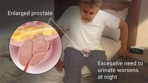 Benign Prostatic Hyperplasia - How To Guide | Tips And Tricks | Tutorials | Africa | Europe ...