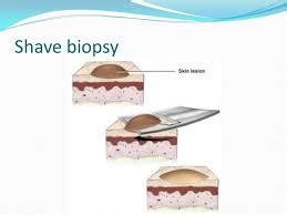 Mole Grew Back Rapidly After Shave Biopsy Was Normal » Scary Symptoms