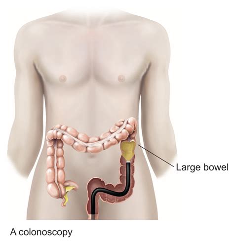 Upper GI endoscopy & colonoscopy in Exeter, Devon | Exeter Gut Clinic