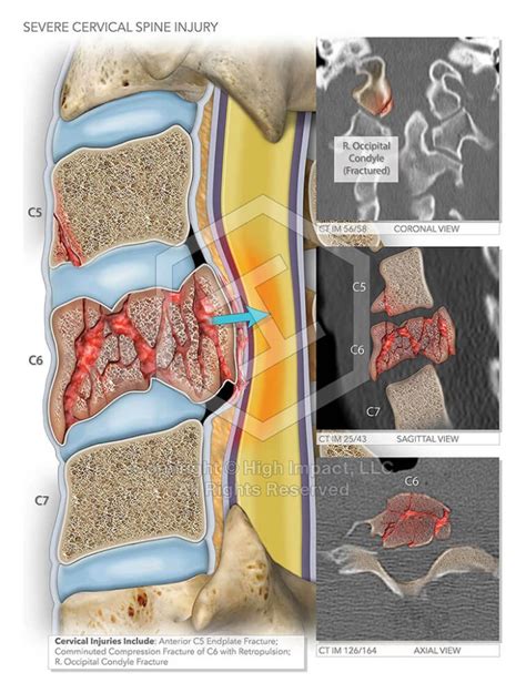 Cervical Spine Injury | High Impact, LLC