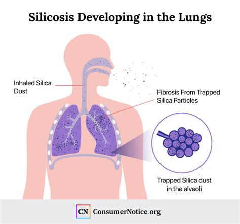 Silicosis: Symptoms, Causes, Treatment and Prevention