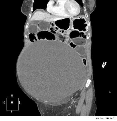 Giant Mesenteric Cyst as a Cause of Intestinal Obstruction | Cirugía ...