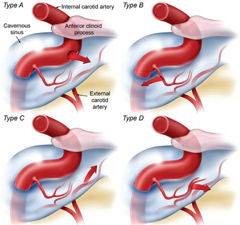 Endovascular Management Of Carotid-Cavernous Fistula (CCF) | Neuro Doctors