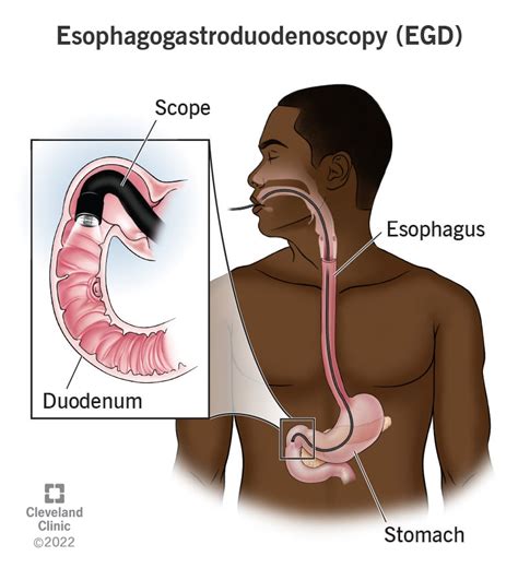 Esophagogastroduodenoscopy (EGD Test): Definition & Procedure