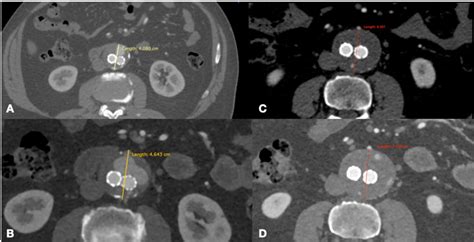 Figure 1 from Trans-limb embolization for treatment of Type 2 endoleak ...