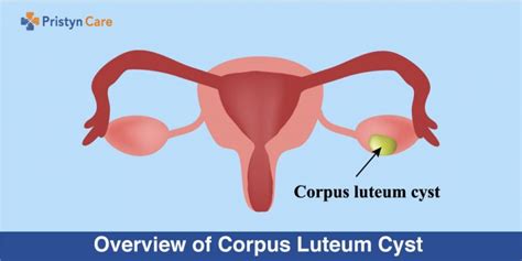 Overview of Corpus Luteum Cyst - Pristyn Care