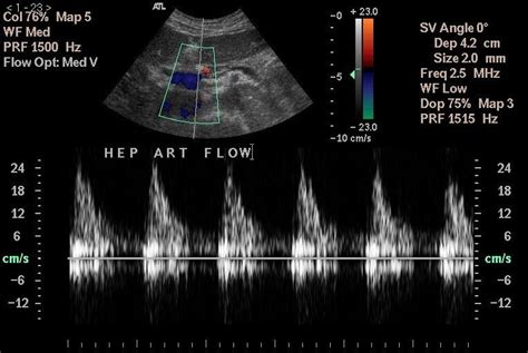 Common Hepatic Artery Ultrasound